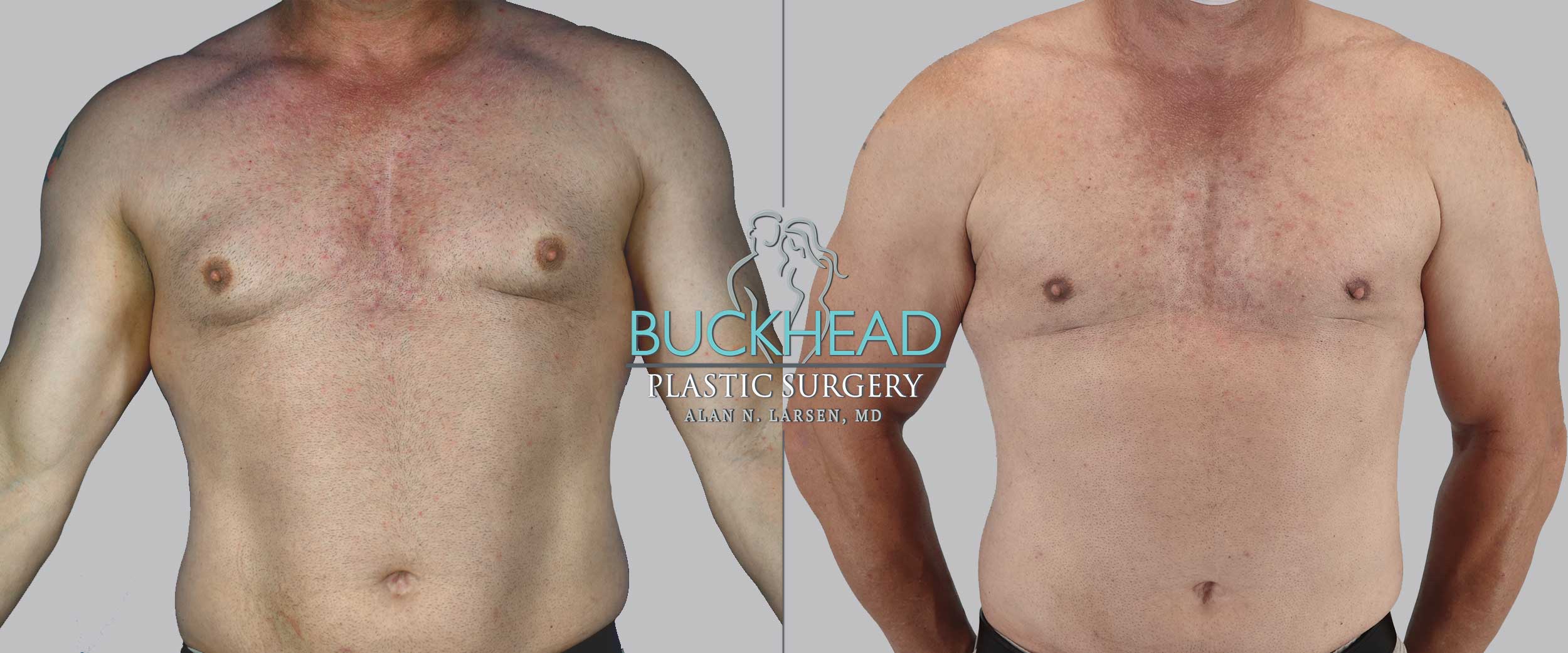 Male breast aug reduction