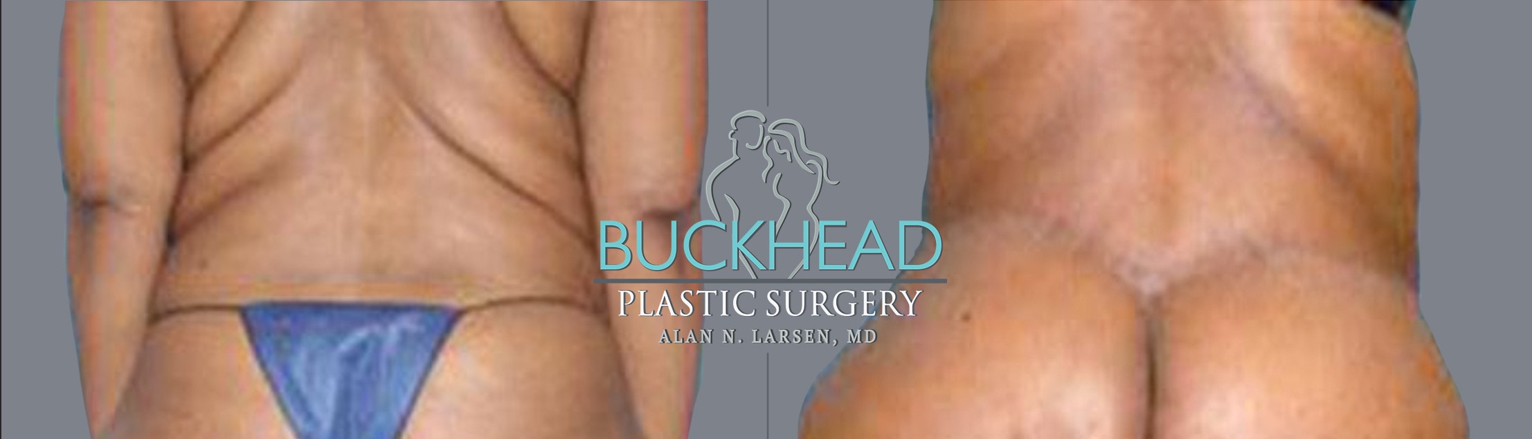 Before and After Photo Gallery | Upper Back Lift | Buckhead Plastic Surgery | Alan N. Larsen, MD | Board-Certified Plastic Surgeon | Atlanta GA