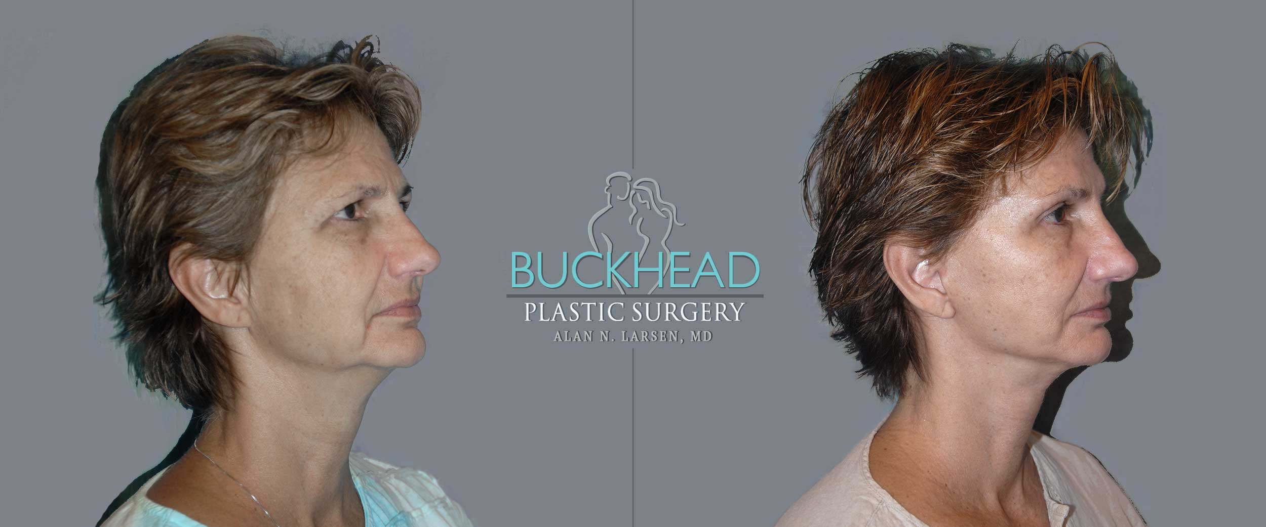Before and After Photo Gallery | Mini Facelift | Buckhead Plastic Surgery | Alan N. Larsen, MD | Double Board-Certified Plastic Surgeon | Atlanta GA