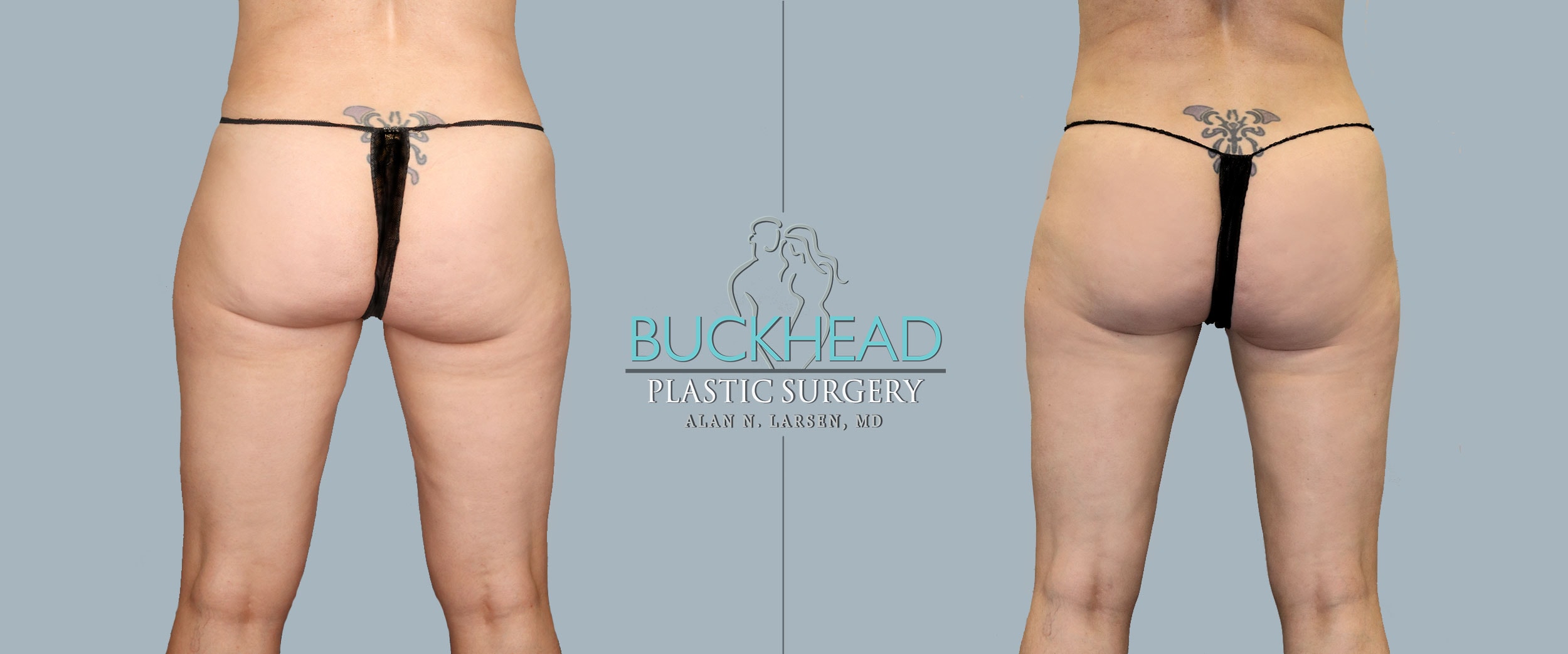 Before-and-After-Photo-Gallery-liposuction-Buckhead-Plastic-Surgery-Alan-N.-Larsen,-MD-Board-Certified-Plastic-Surgeon-Atlanta-GA-Inner-Thighs-Back
