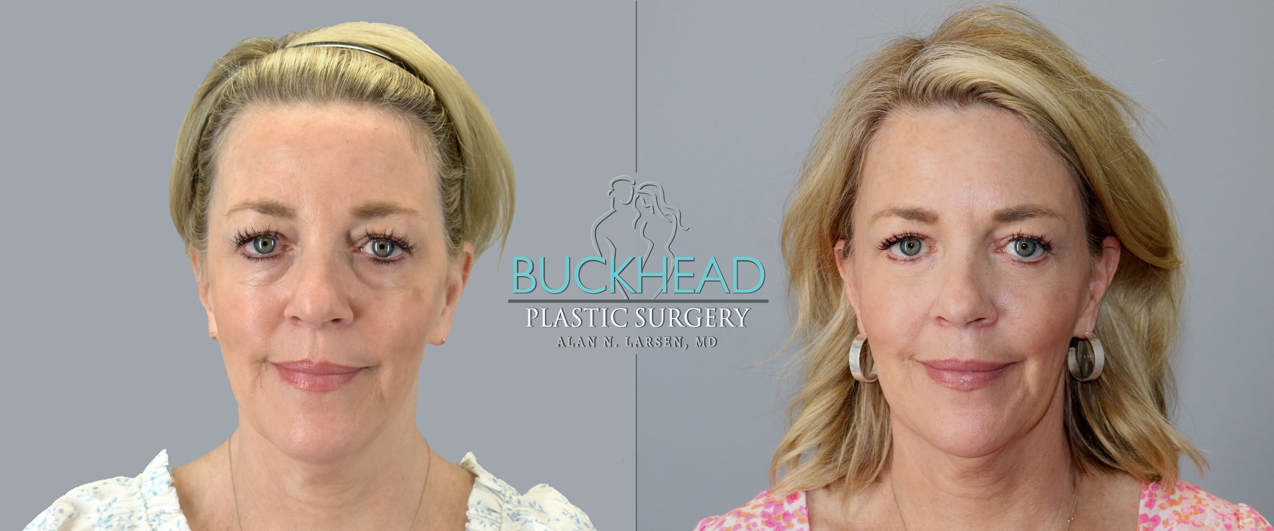 Eyelid surgery clearance atlanta