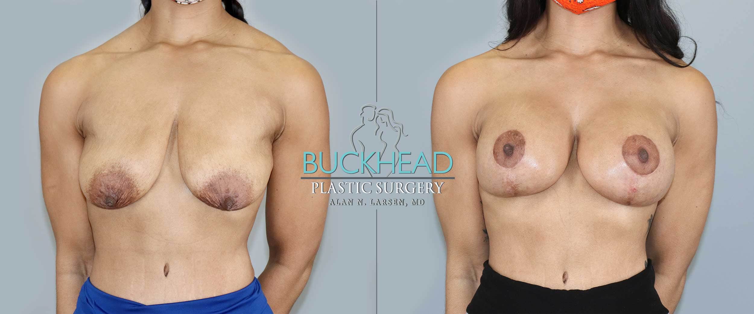 Before and After Photo Gallery | Breast Lift with Augmentation | Buckhead Plastic Surgery | Alan N. Larsen, MD | Board-Certified Plastic Surgeon | Atlanta GA