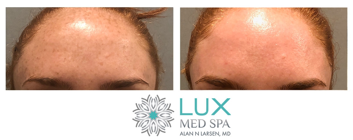 LUX Med Spa at Before and After Photo Gallery | BBL Broadband Light | Buckhead Plastic Surgery | Alan N. Larsen, MD | Double Board-Certified Plastic Surgeon | Atlanta GA