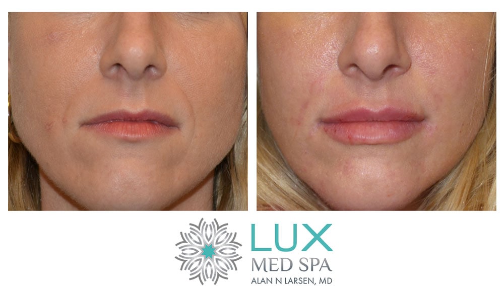 Before and After Photo Gallery | Dermal Fillers - Juvéderm® | LUX Med Spa at Buckhead Plastic Surgery | Alan N. Larsen, MD | Double Board-Certified Plastic Surgeon | Atlanta GA