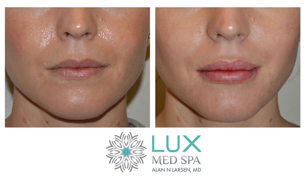 Before and After Photo Gallery | Dermal Fillers - Juvéderm® | LUX Med Spa at Buckhead Plastic Surgery | Alan N. Larsen, MD | Double Board-Certified Plastic Surgeon | Atlanta GA