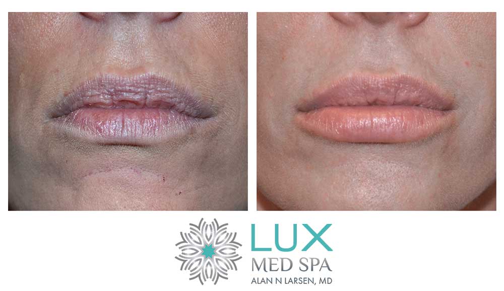 Before and After Photo Gallery | Dermal Fillers - Juvéderm® | LUX Med Spa at Buckhead Plastic Surgery | Alan N. Larsen, MD | Board-Certified Plastic Surgeon | Atlanta GA