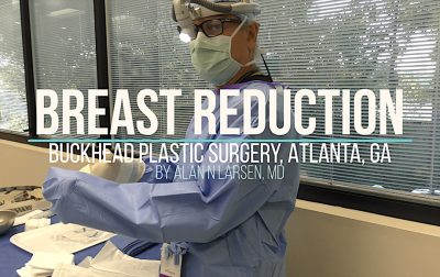 Breast Reduction Procedure and Results Video | Buckhead Plastic Surgery