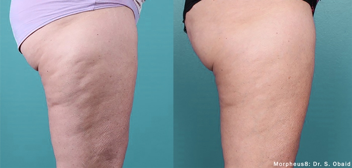 Cellulite Treatment with Profound RF Atlanta, Georgia