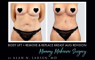 Before and After Photo Gallery | Body Lift + Remove & Replace Breast Aug Revision | Buckhead Plastic Surgery | Alan N. Larsen, MD | Board-Certified Plastic Surgeon | Atlanta GA