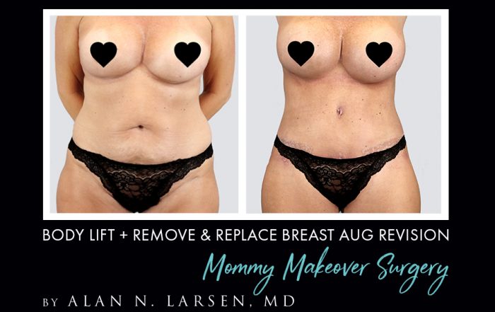 Before and After Photo Gallery | Body Lift + Remove & Replace Breast Aug Revision | Buckhead Plastic Surgery | Alan N. Larsen, MD | Board-Certified Plastic Surgeon | Atlanta GA