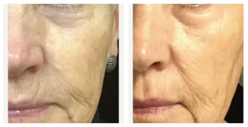 Opus Plasma at Buckhead Plastic Surgery in Atlanta offers visible results after as few as one treatment