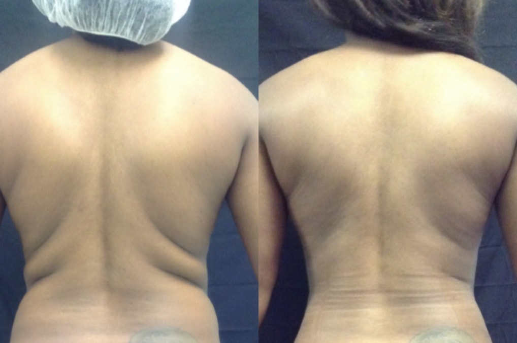 Butt Lift Before and After: Fat Transfers Amazing Results!