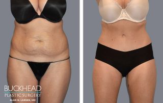 tummy tuck on the size of their waist. It’s especially common for women to be interested in this procedure after having children. The natural changes can leave you feeling less like yourself, and you might notice your clothes fitting differently. Although we believe all bodies are reasonable, we want you to feel confident when looking in the mirror. Sometimes a procedure like a tummy tuck can help you find the confidence you’re looking for.