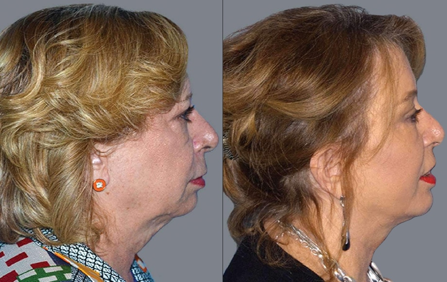 Does a facelift make you look younger?