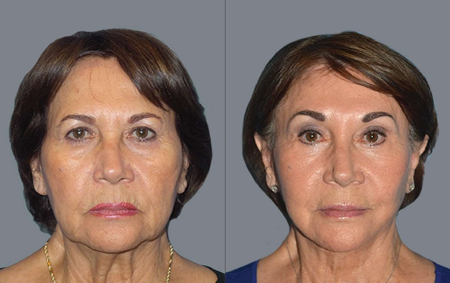 Plastic Surgery before And After Face: Transform Your Look with These Dramatic Results