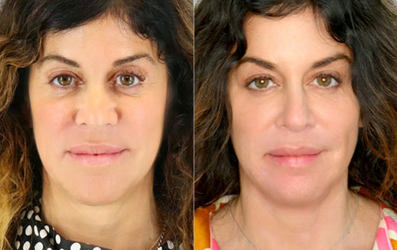 The Pros & Cons of Eye Lift Surgery (The Bleph) In Atlanta Blog