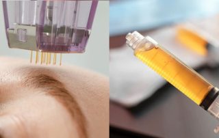 Close-up of microneedling device on skin and PRP syringe, showing benefits of microneedling with platelet-rich plasma and how enhances skin rejuvenation