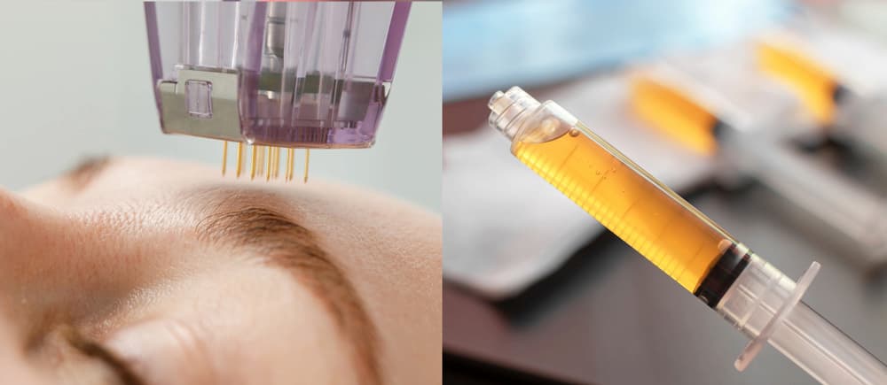 Close-up of microneedling device on skin and PRP syringe, showing benefits of microneedling with platelet-rich plasma and how enhances skin rejuvenation