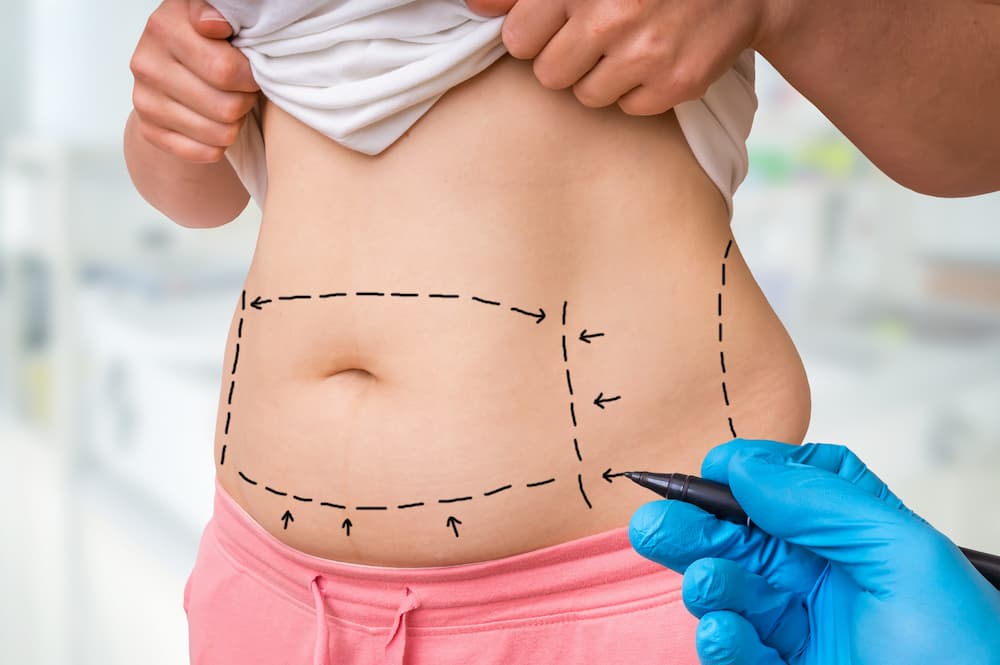 A surgeon marking a patient’s abdominal area with dashed lines in preparation for a body contouring procedure such as a tummy tuck or liposuction.