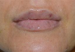Lip Enhancement | Buckhead Plastic Surgery | Board-Certified Plastic Surgeon in Atlanta GA